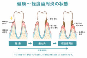 歯周病の進行具合と症状