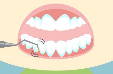 自分でできる歯石除去 その手順4つ 歯石取りをするためには 歯科医師監修
