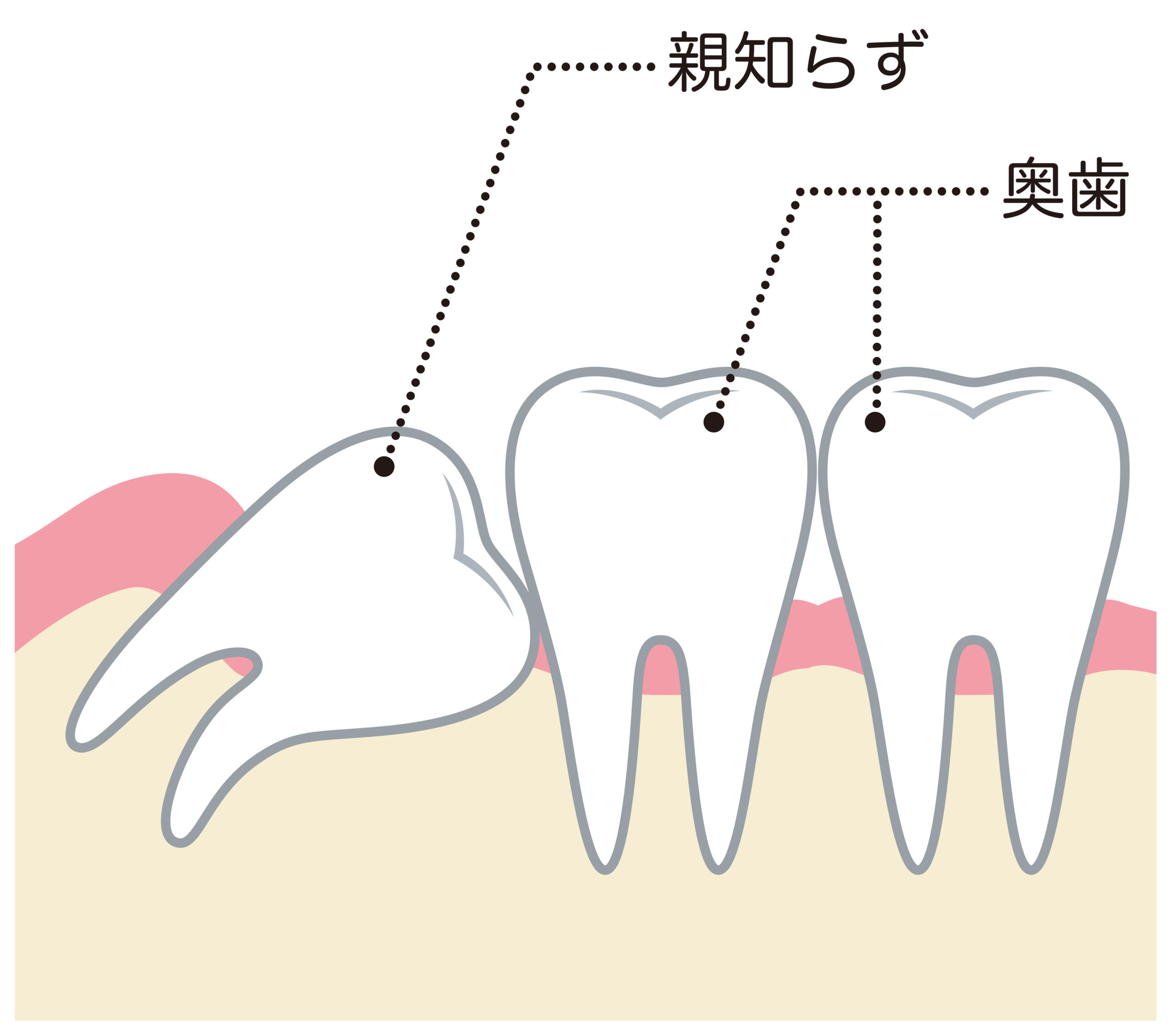 親知らずの痛みの原因4つ 痛い理由は歯茎の炎症や虫歯 その治療法は