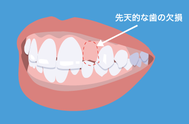 すきっ歯になる2つの原因と歯医者さんでの治療方法 歯のアンテナ