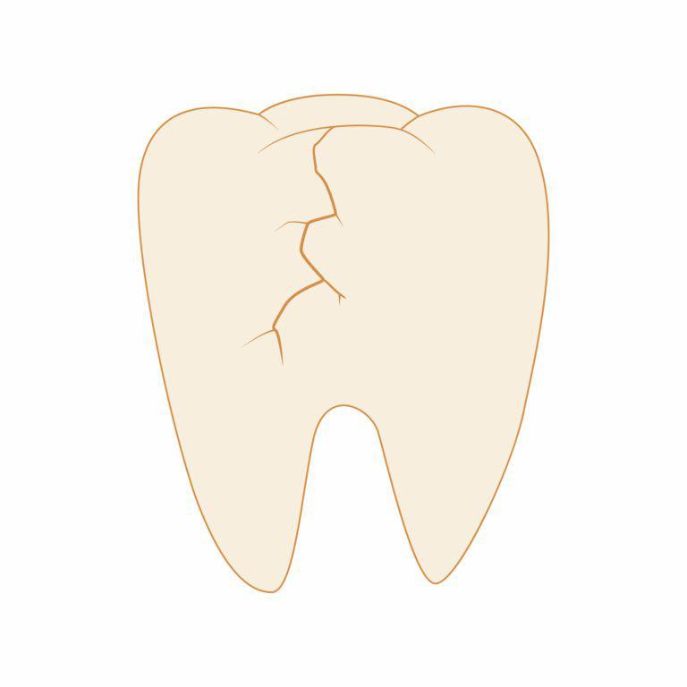 大切な歯を失う歯根破折の原因と歯医者で行う2つの治療法