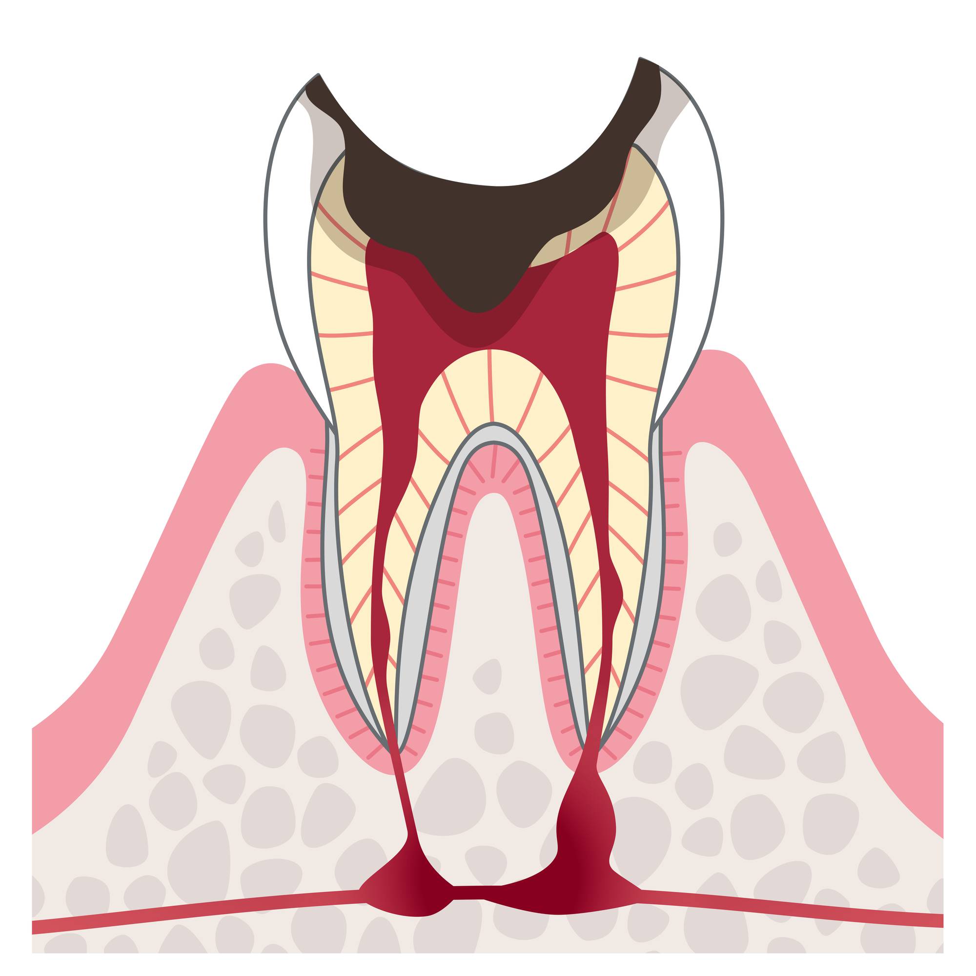 重度虫歯のイラスト