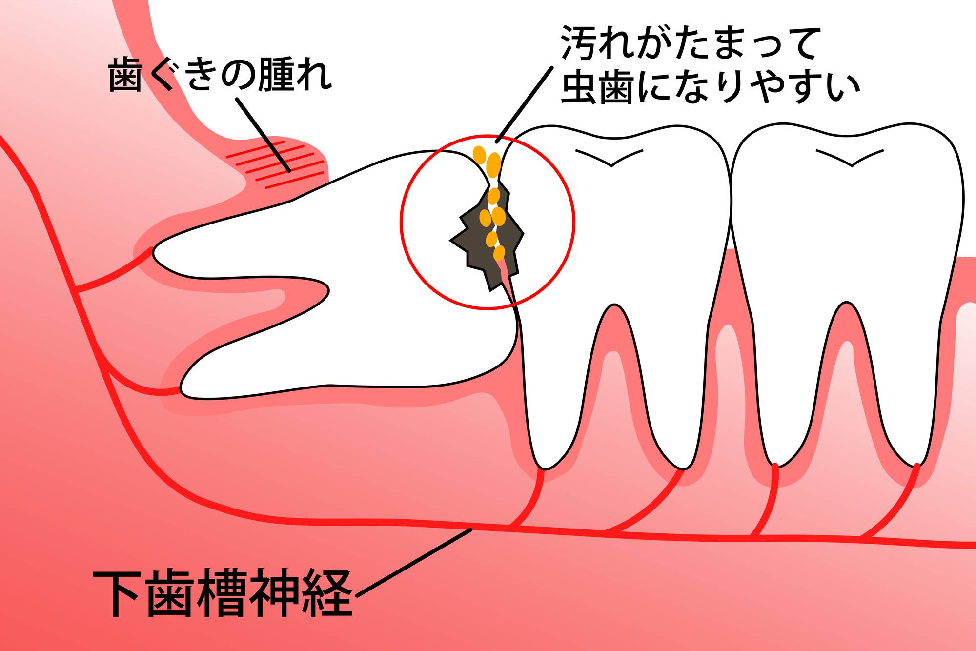 抜歯 喉 の 痛み