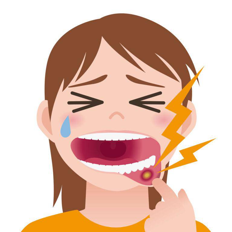 舌の口内炎の種類別・症状や原因、治し方を紹介！口内炎と間違えやすい病気も