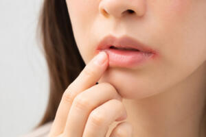 口の端が切れる「口角炎」になったら？原因と対処法